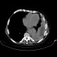 Carcinosis of pericard and pleura, empyema, nephrectomy: CT - Computed tomography